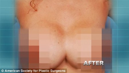 Woman Left With 'Uniboob' After Botched Surgery (Video) - Shy Magazine